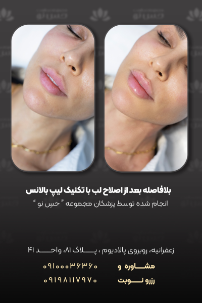 اصلاح فرم لب با تکنیک لیپ بالانس