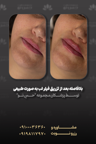 بعد از تزریق فیلر لب