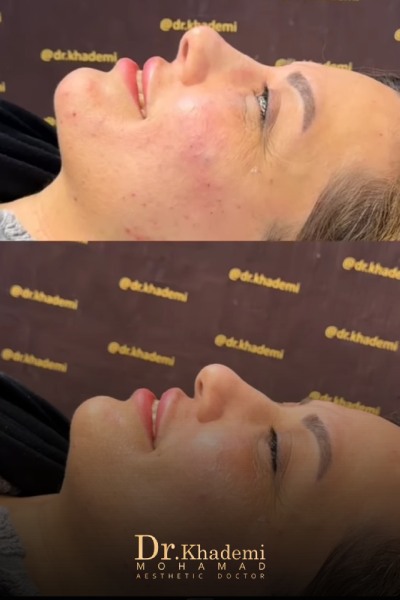 نمونه نتیجه تزریق ژل بینی