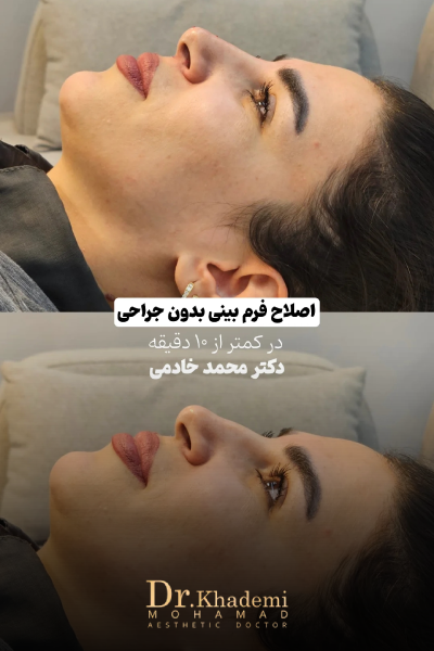 نمونه قبل و بعد تزریق فیلر بینی در کلینیک