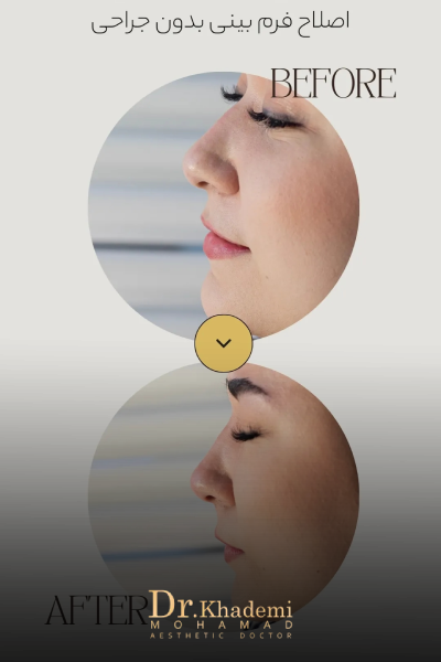 قبل و بعد تزریق فیلر بینی