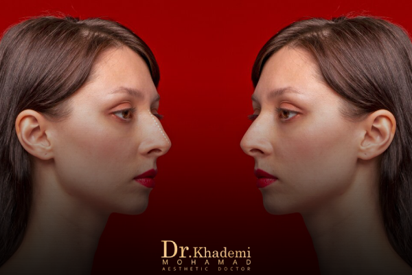 مزایای فیلر بینی