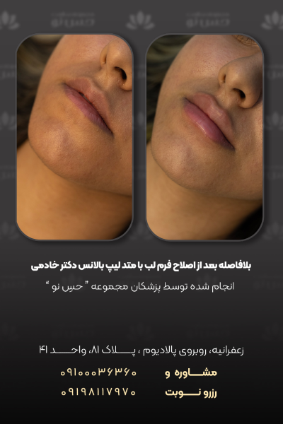 اصلاح فرم لب به روش لیپ بالانس