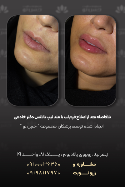 عکس از اصلاح فرم لب