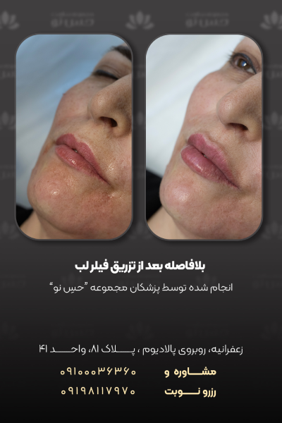 بعد از فیلر لب