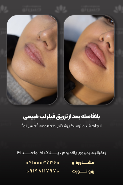 فیلر لب طبیعی