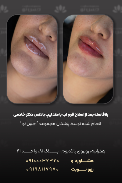 اصلاح فرم لب با متد لیپ بالانس