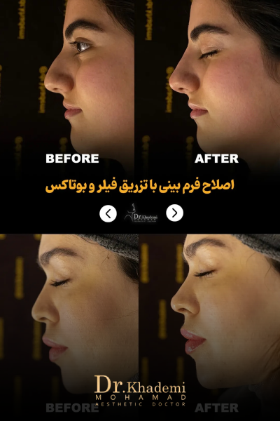 تصویر قبل و بعد از تزریق فیلر بینی