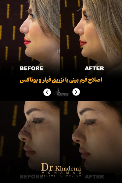 عکس قبل و بعد تزریق فیلر بینی