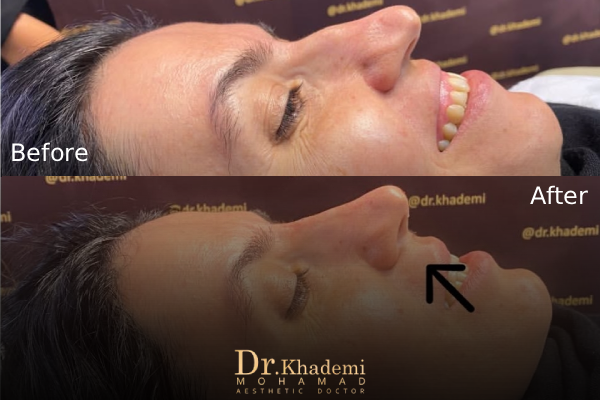 فیلر بینی قوزدار