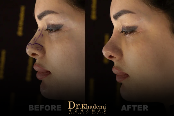 مراقبت های بعد از تزریق فیلر بینی