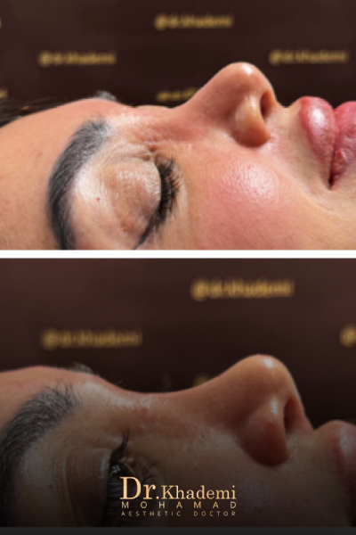 عکس اصلاح فرم بینی