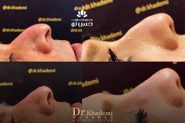 اصلاح فرم بینی بدون جراحی