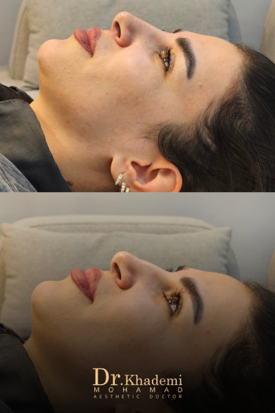 اصلاح فرم بینی