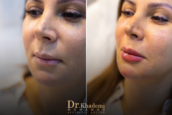 نمونه تزریق فیلر لب