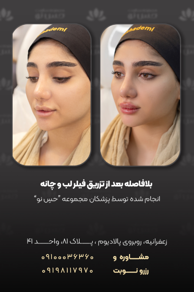 عکس قبل و بعد تزریق فیلر لب