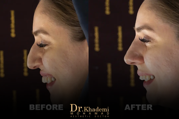 هزینه تزریق فیلر بینی