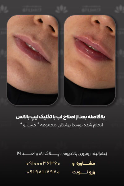 عکی قبل و بعد فیلر لب