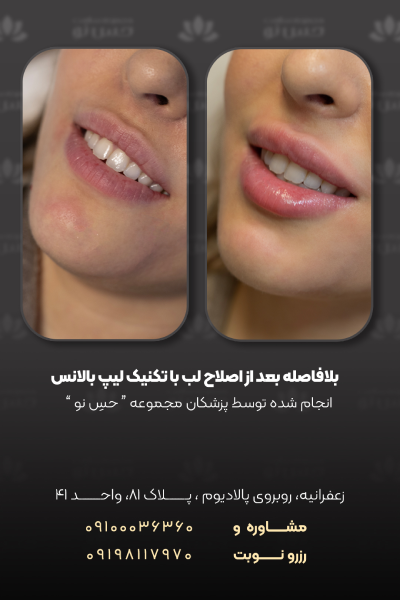 دقیقا بعد از تزریق فیلر لب