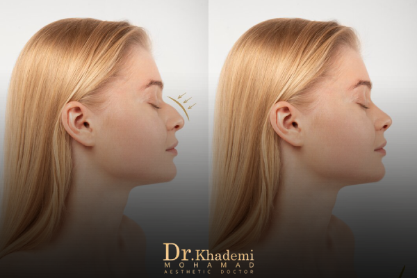 ورم بعد از تزریق فیلر بینی