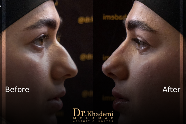 انواع فیلر بینی