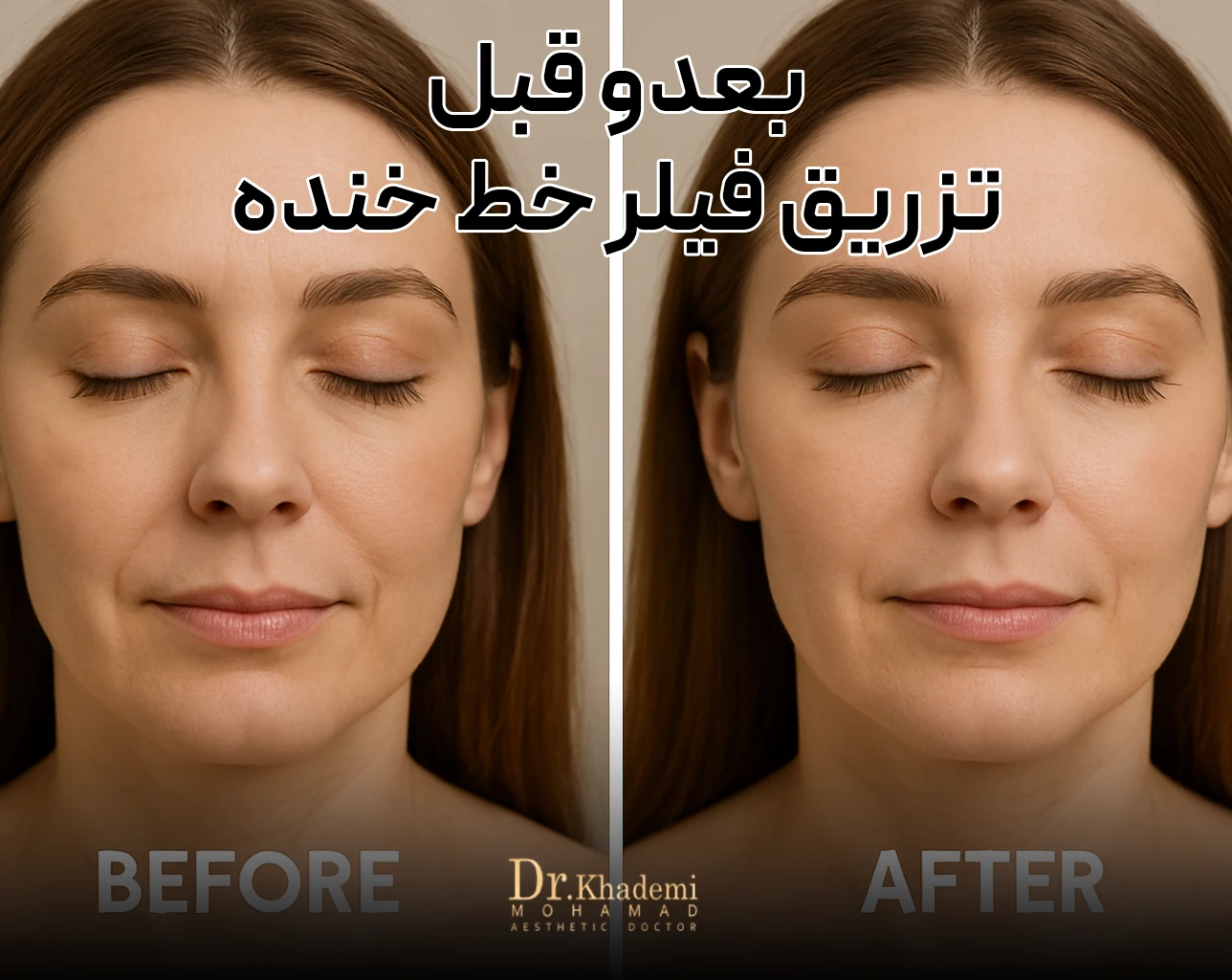 دو تا عکس صورت که کنار هم هست و نشون دهنده قبل و بعد از  تزریق فیلر خنده