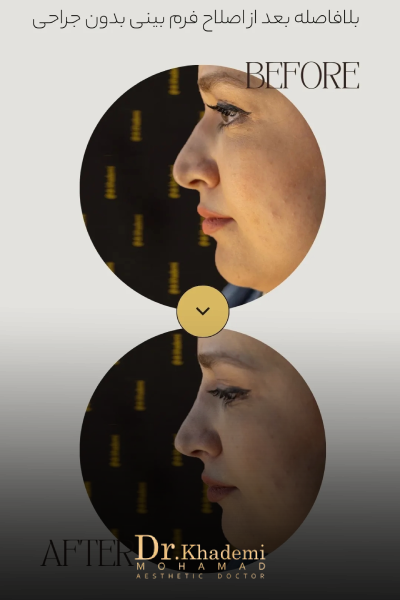 تصویر قبل و بعد اصلاح فرم بینی با فیلر