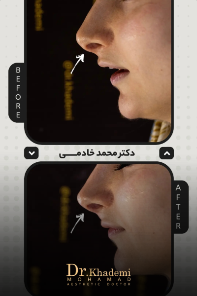 نتیجه تزریق فیلر بینی بدون جراحی