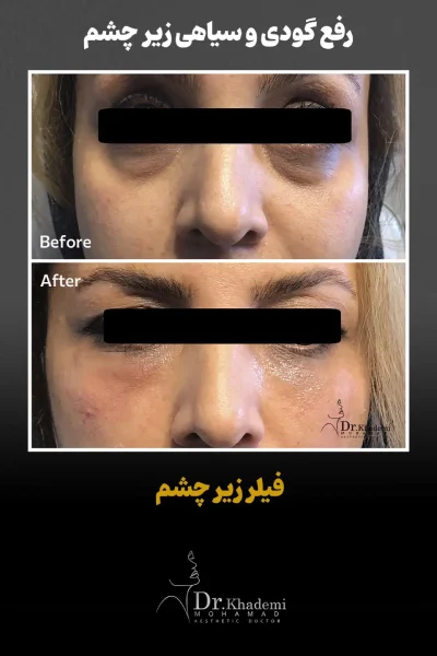 تصویر قبل و بعد تزربق فیلر زی چشم برای یک خانم میانسال به جهت رفع گودی و سیاهی زیر چشم