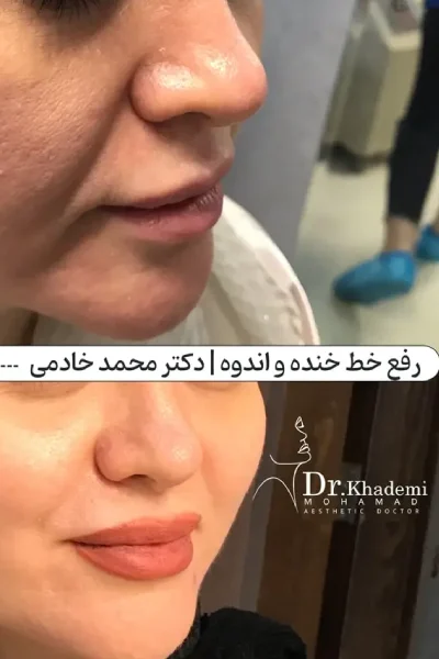 غکس تزریق فیلر خط خنده برای یک خانم هم قبل و هم بعد