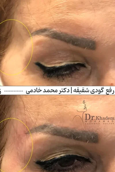 قسمتی از شقیقه یک خانم بعد از تزریق فیلر شقیقه