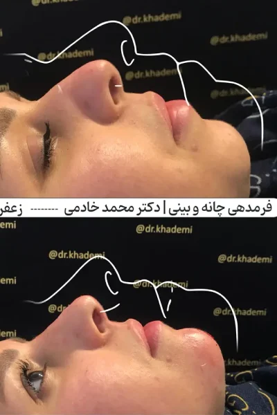 عکس قبل و بعد یک خانم جوان بعد از تزریق فیلر بینی