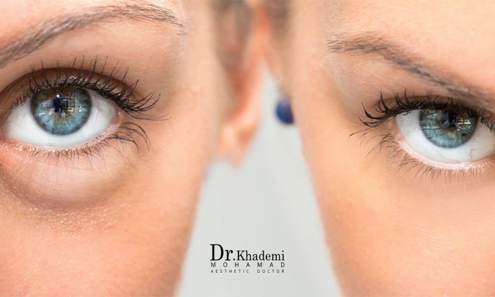 قبل و بعد درمان ورم زیر چشم بعد از تزریق فیلر