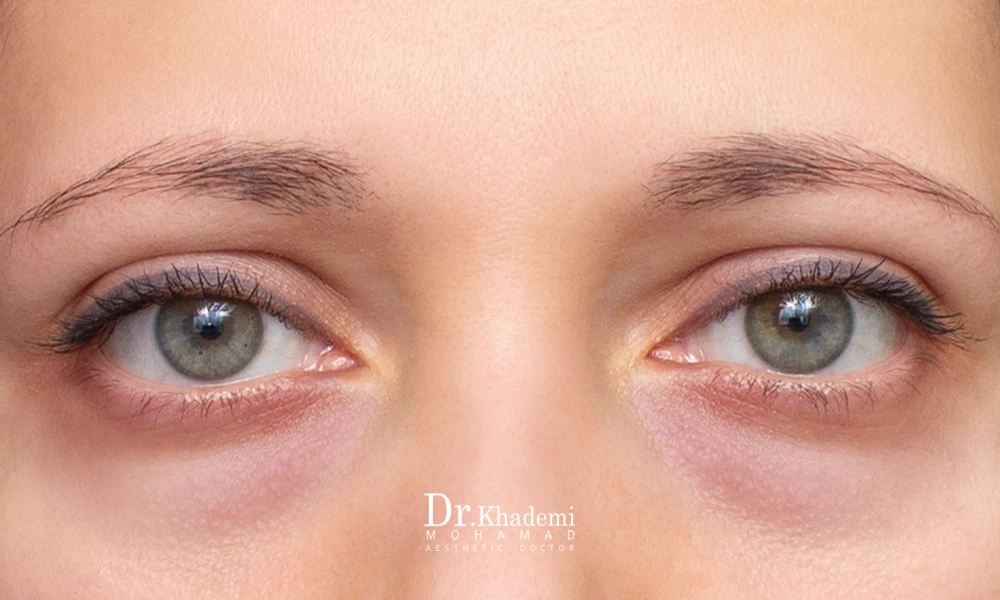 درمان ورم زیر چشم بعد از تزری فیلر