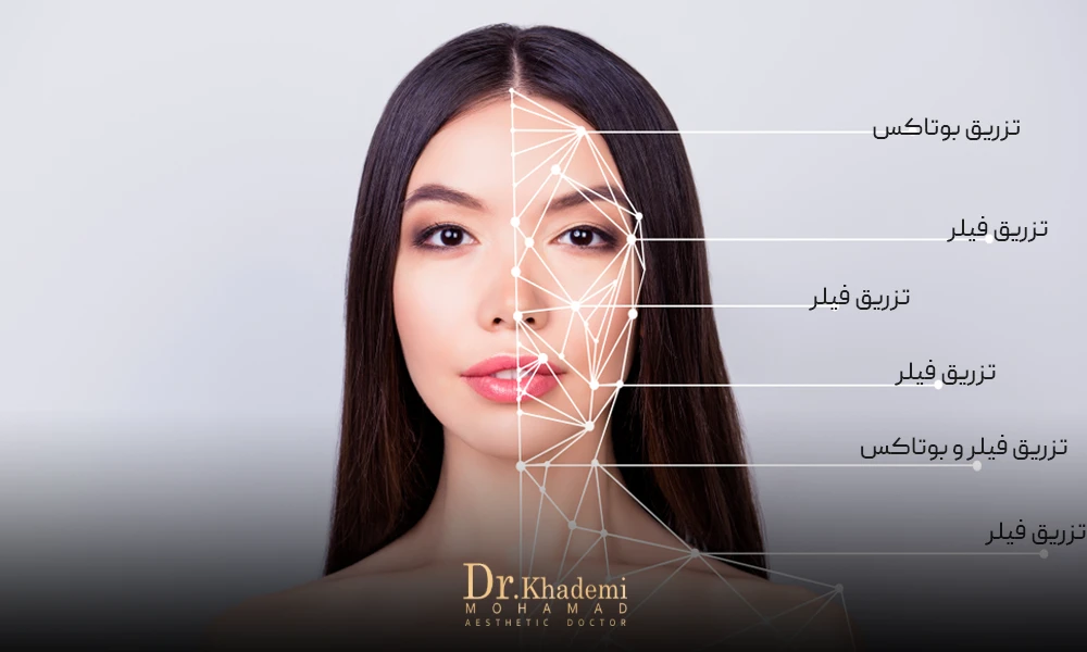تصویر یک حانم که نواحی تزریق فیلر و بوتاکس در آن مشخص شد