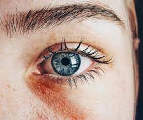 تصویر بیماری هماتوم- عوارض تزریق نامناسب فیلر زیر چشم