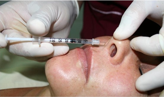 تصویر روش انجام تزریق بوتاکس به پره‌های بینی
