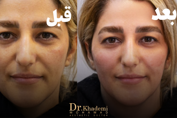 نمونه کار تزریق فیلر گونه