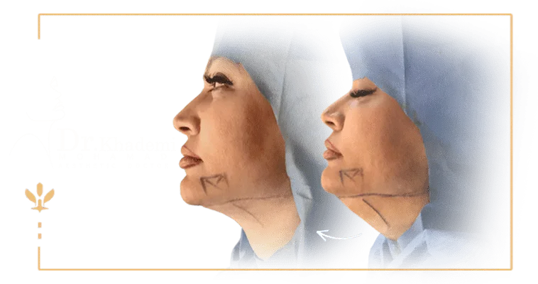 رفع غبغب