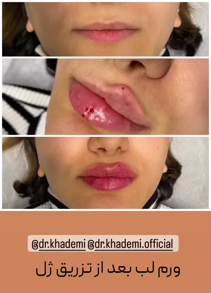 یه تا عکس از لب که قبل ای تزریق و بعد از ترزیق ژل و ورم لب است