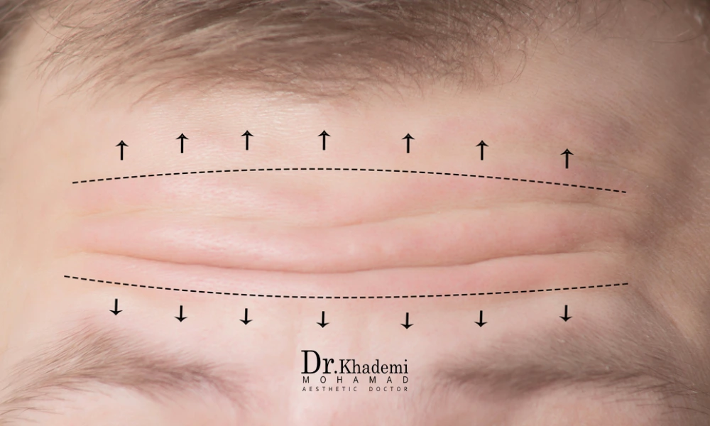 متقاضی با پیشانی چروک و خطوط بسیار که قرار است لیفت پیشانی با نخ انجام دهد. 