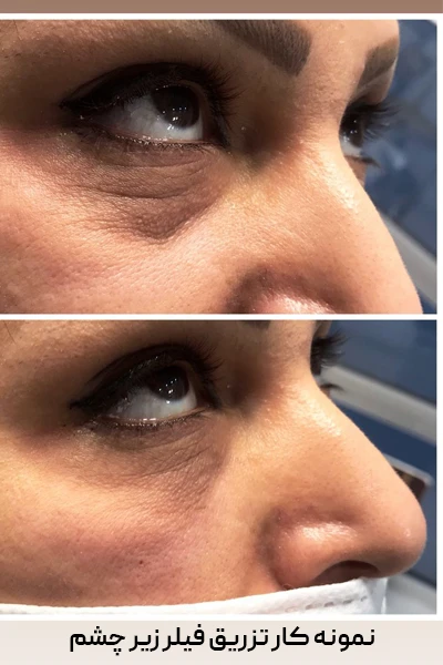 قبل و بعد از تزریق فبلر زیر چشم