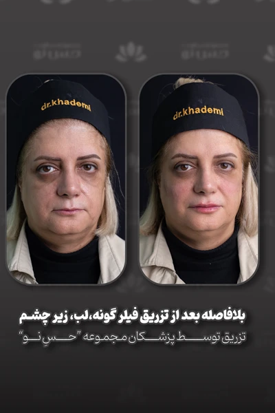 قبل و بعد تزریق بیلر زیر چشم