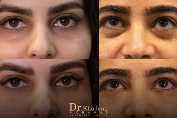 تزریق فیلر زیر چشم برای رفع گودی