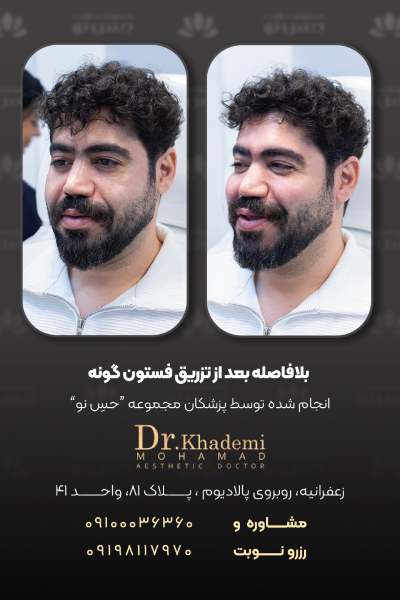 تصویر تزریق فیلر زیر چشم