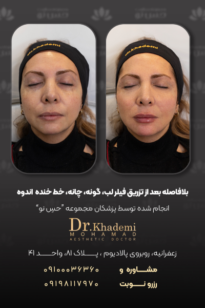 نمونه کار از تزریق فیلر زیر چشم