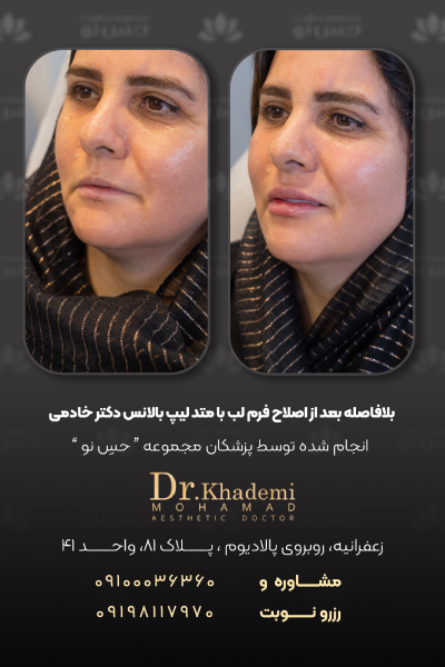 تزریق فیلر زیر چشم