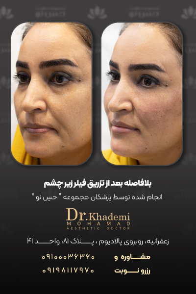 نمونه تزریق فیلر زیر چشم