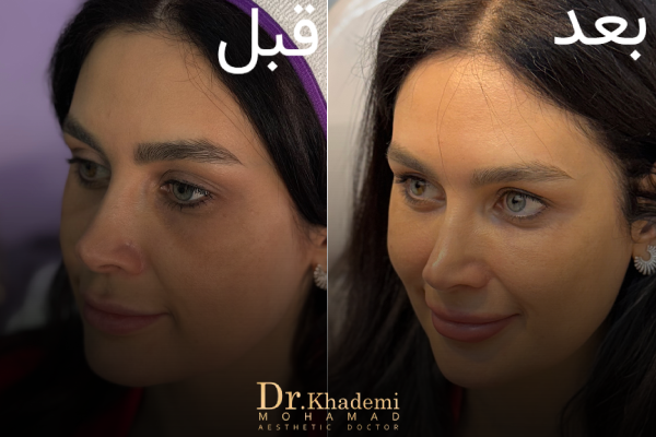 Sample photo of under-eye filler injection