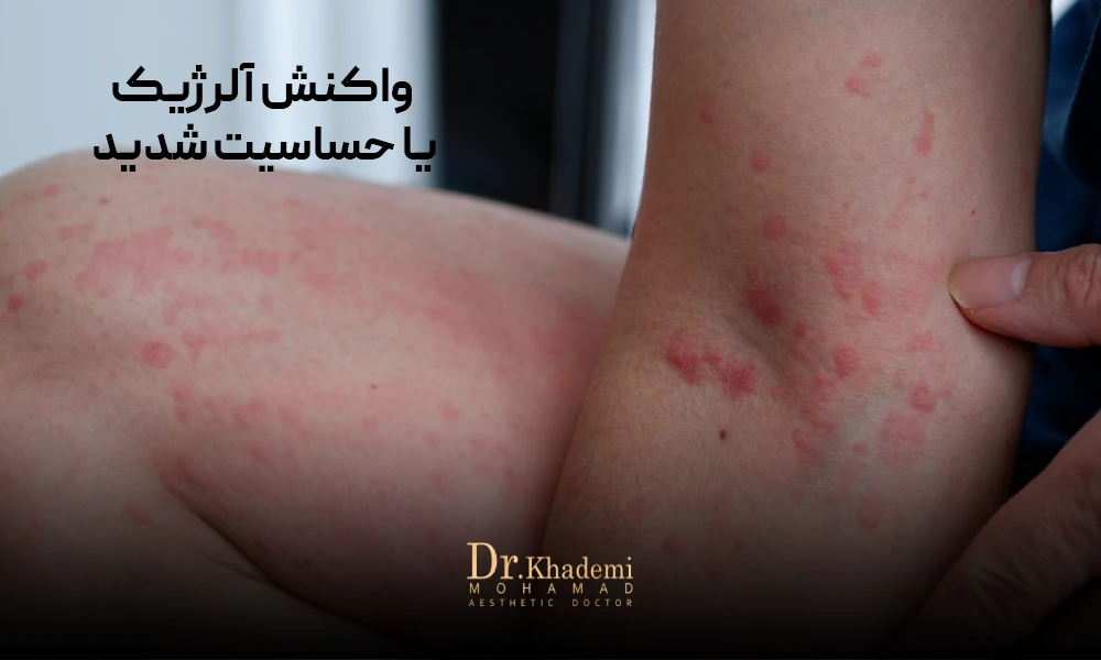 پوست بدن که به دلیل حساسیت و آلرژی کهیر زده